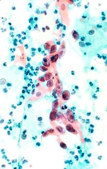 Pap stain of cervical squamous cell carcinoma (200x)